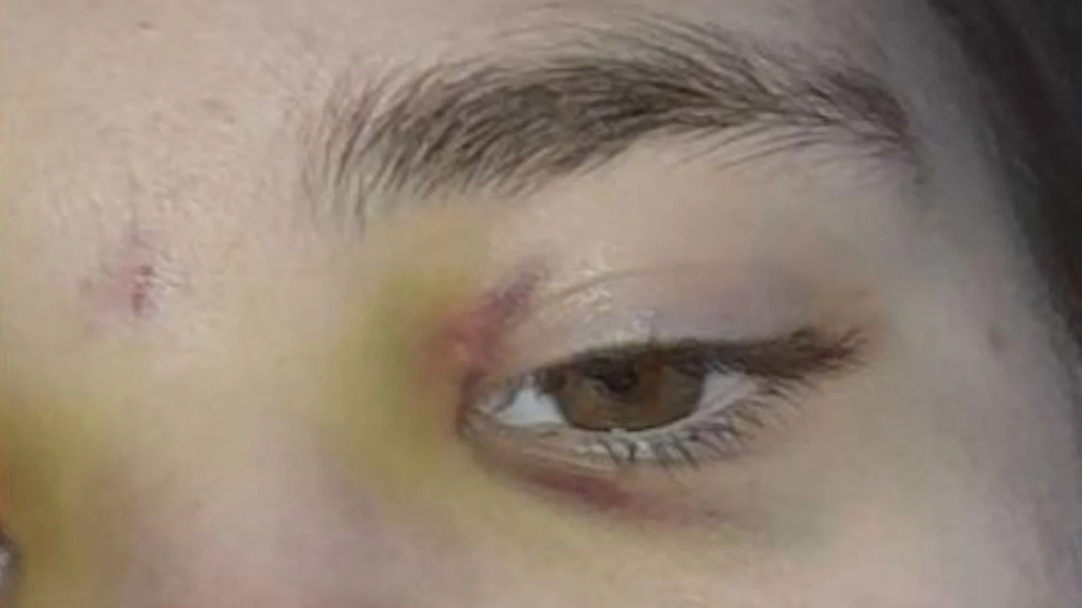 Man slaat meisje (15) in elkaar, oogkassen en borstkas gekneusd